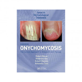 Onychomycosis 