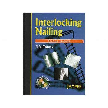 Interlocking Nailing 