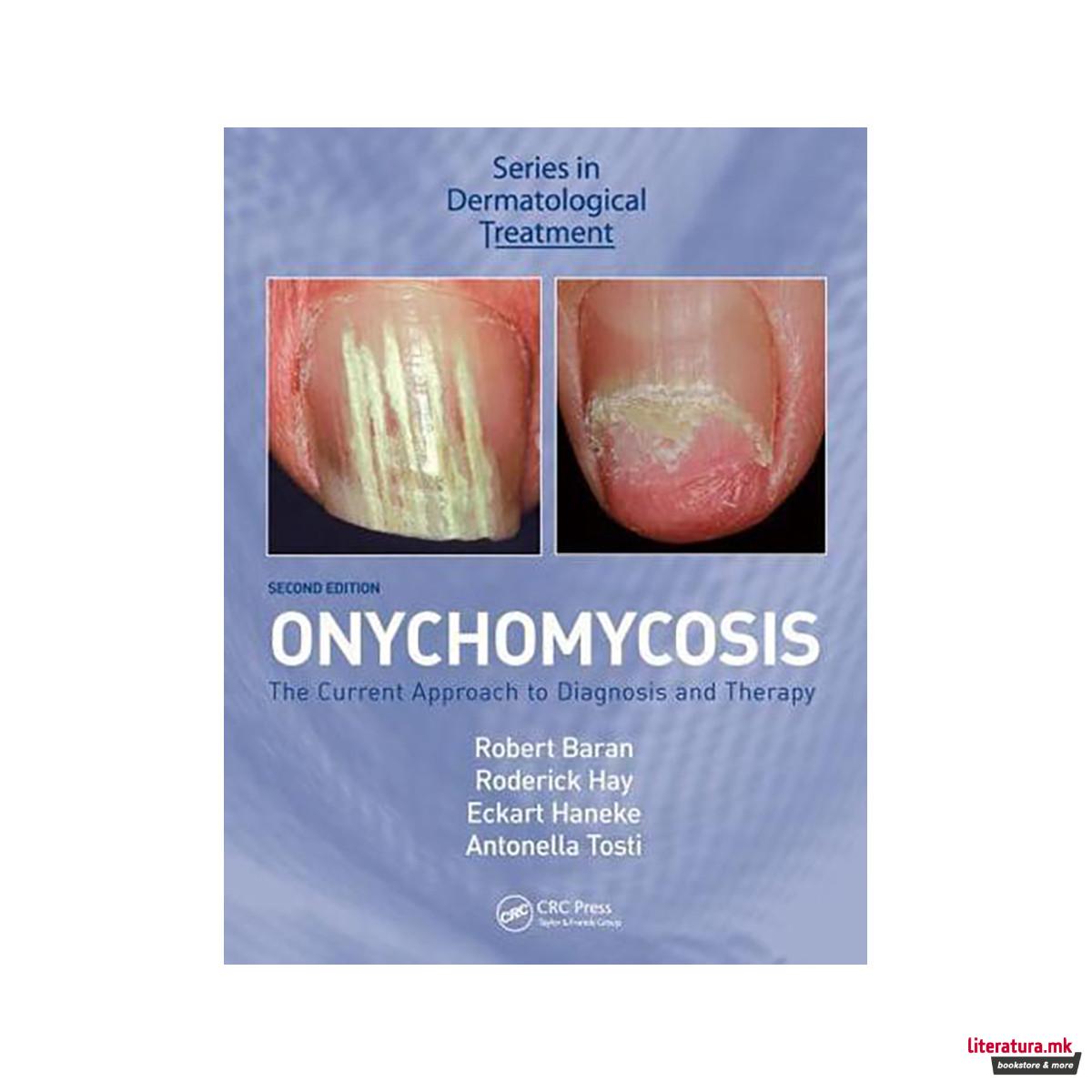 Onychomycosis 